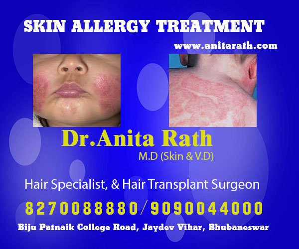 Best skin allergy treatment clinic in Bhubaneswar near me
